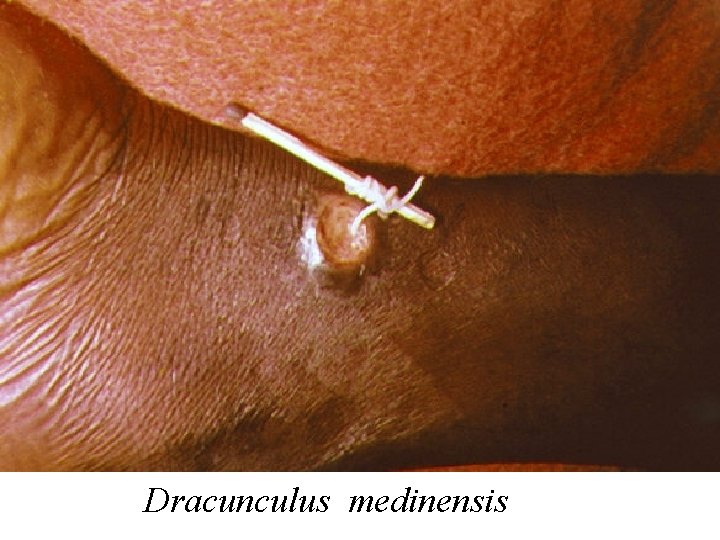 Dracunculus medinensis 