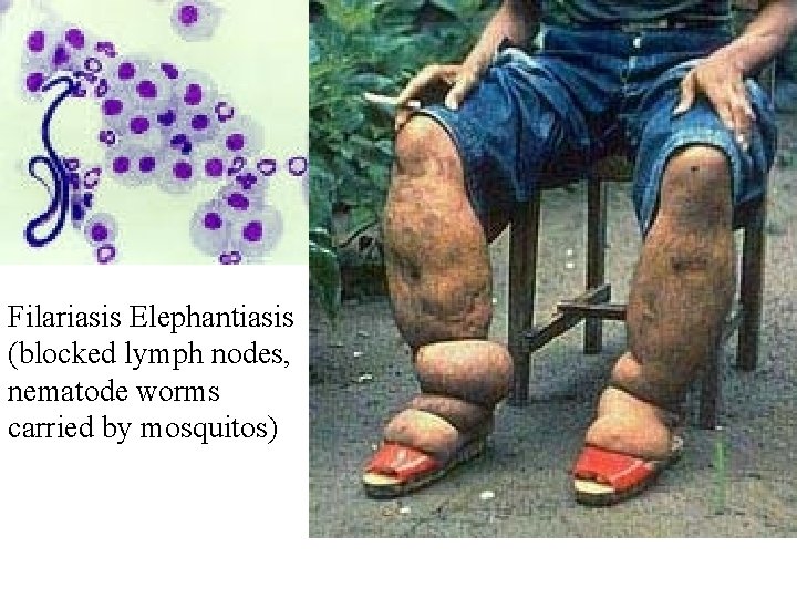 Filariasis Elephantiasis (blocked lymph nodes, nematode worms carried by mosquitos) 
