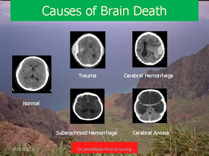 Causes of Brain Death Trauma Cerebral Hemorrhage Normal Subarachnoid Hemorrhage 9/18/2020 Dr. yekehfallah-PHd of