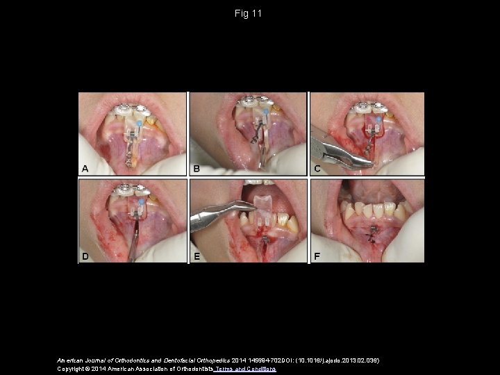Fig 11 American Journal of Orthodontics and Dentofacial Orthopedics 2014 145694 -702 DOI: (10.