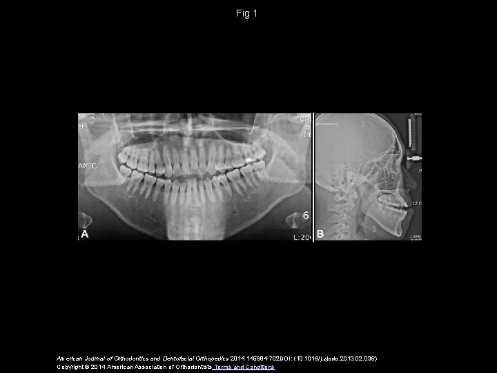 Fig 1 American Journal of Orthodontics and Dentofacial Orthopedics 2014 145694 -702 DOI: (10.