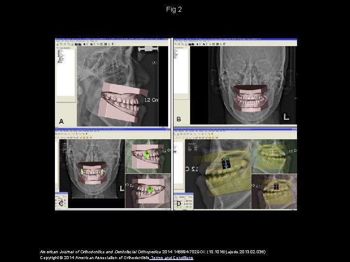 Fig 2 American Journal of Orthodontics and Dentofacial Orthopedics 2014 145694 -702 DOI: (10.