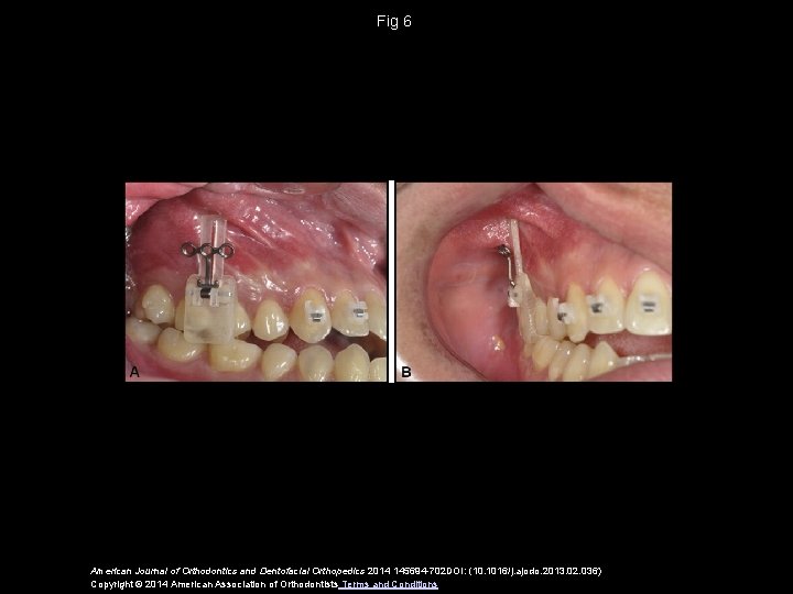 Fig 6 American Journal of Orthodontics and Dentofacial Orthopedics 2014 145694 -702 DOI: (10.