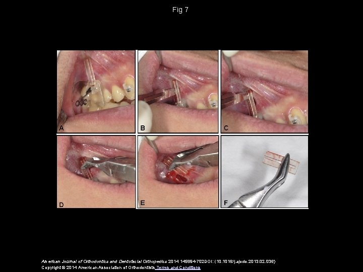 Fig 7 American Journal of Orthodontics and Dentofacial Orthopedics 2014 145694 -702 DOI: (10.