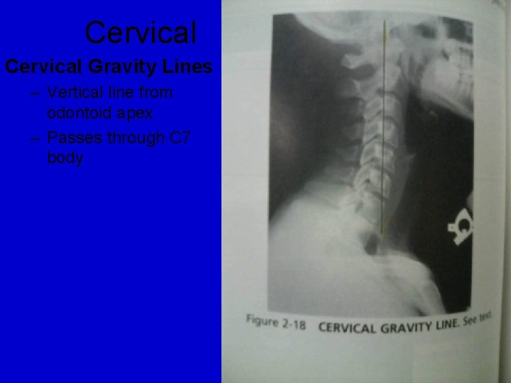 Cervical Gravity Lines – Vertical line from odontoid apex – Passes through C 7