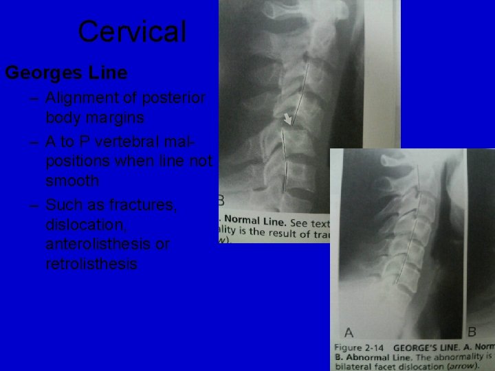 Cervical Georges Line – Alignment of posterior body margins – A to P vertebral
