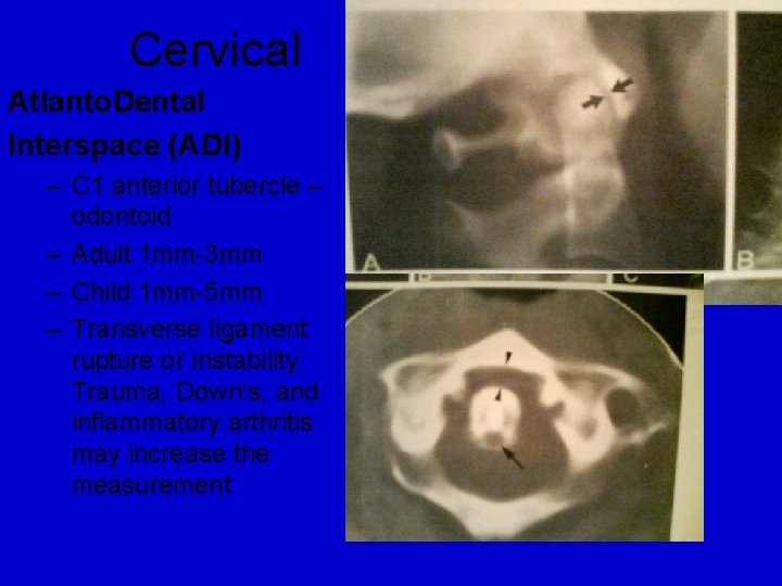 Cervical Atlanto. Dental Interspace (ADI) – C 1 anterior tubercle – odontoid – Adult