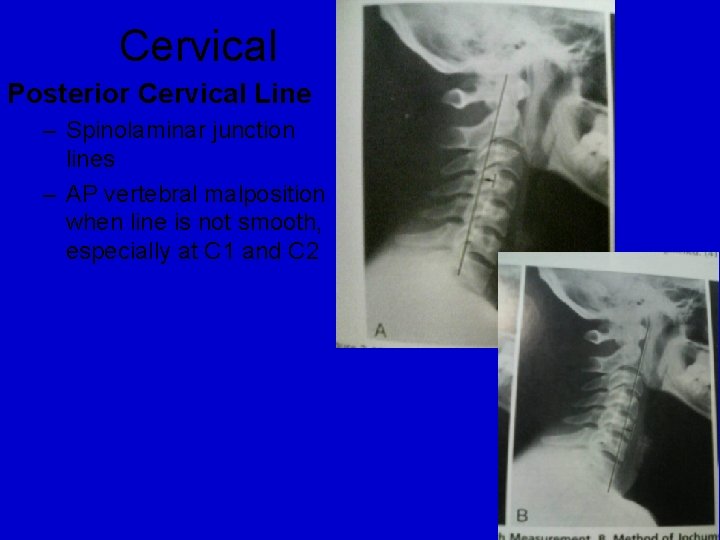 Cervical Posterior Cervical Line – Spinolaminar junction lines – AP vertebral malposition when line