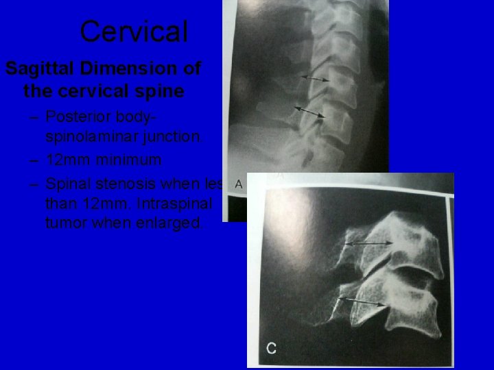 Cervical Sagittal Dimension of the cervical spine – Posterior bodyspinolaminar junction. – 12 mm Cervical Sagittal Dimension of the cervical spine – Posterior bodyspinolaminar junction. – 12 mm