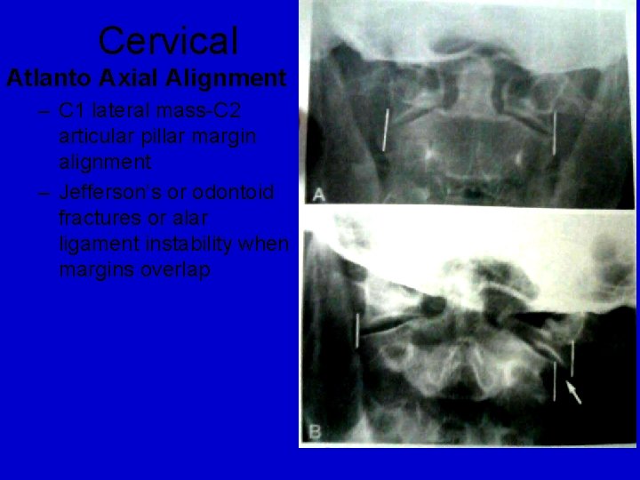 Cervical Atlanto Axial Alignment – C 1 lateral mass-C 2 articular pillar margin alignment