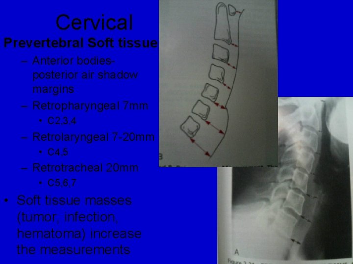 Cervical Prevertebral Soft tissue – Anterior bodiesposterior air shadow margins – Retropharyngeal 7 mm Cervical Prevertebral Soft tissue – Anterior bodiesposterior air shadow margins – Retropharyngeal 7 mm