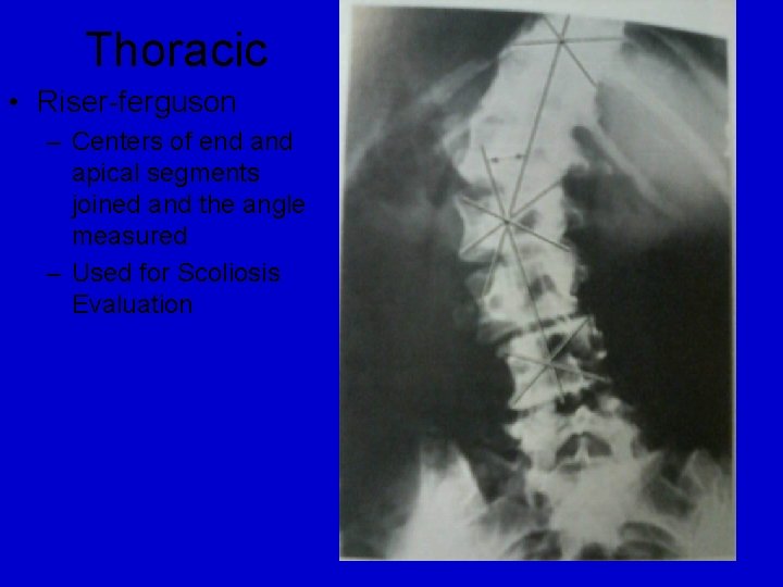 Thoracic • Riser-ferguson – Centers of end apical segments joined and the angle measured