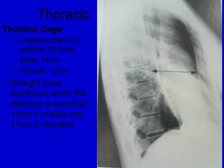 Thoracic Cage – Posterior sternumanterior T 8 body – Male: 14 cm – Female: