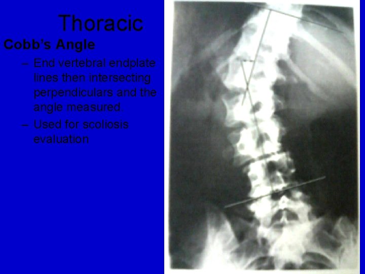 Thoracic Cobb’s Angle – End vertebral endplate lines then intersecting perpendiculars and the angle
