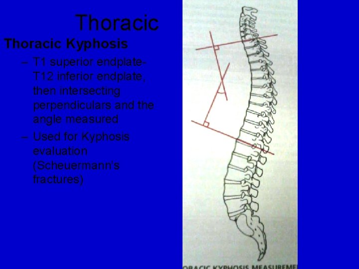 Thoracic Kyphosis – T 1 superior endplate. T 12 inferior endplate, then intersecting perpendiculars