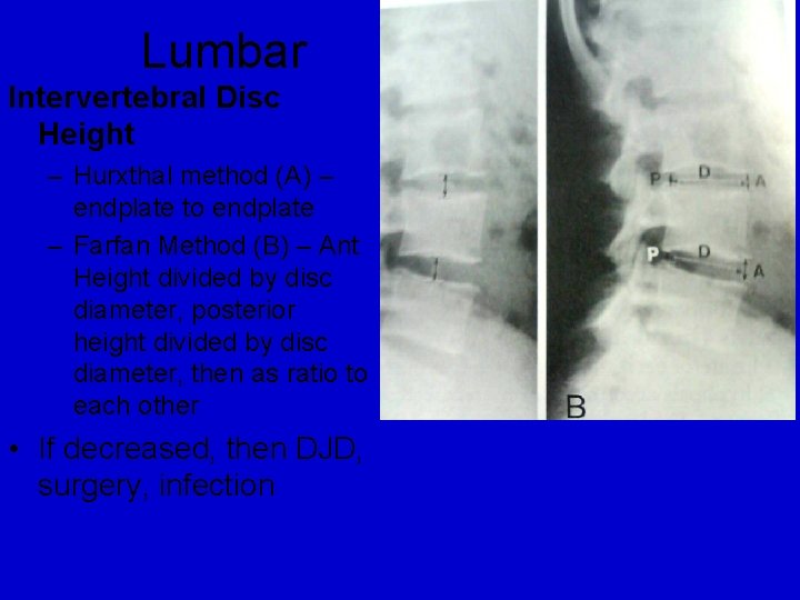 Lumbar Intervertebral Disc Height – Hurxthal method (A) – endplate to endplate – Farfan