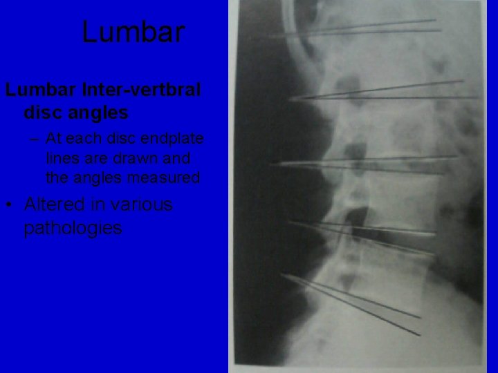 Lumbar Inter-vertbral disc angles – At each disc endplate lines are drawn and the
