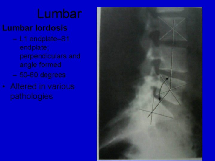 Lumbar lordosis – L 1 endplate–S 1 endplate; perpendiculars and angle formed – 50