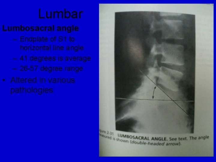 Lumbar Lumbosacral angle – Endplate of S 1 to horizontal line angle – 41