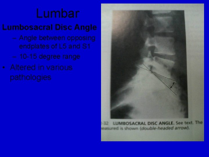 Lumbar Lumbosacral Disc Angle – Angle between opposing endplates of L 5 and S