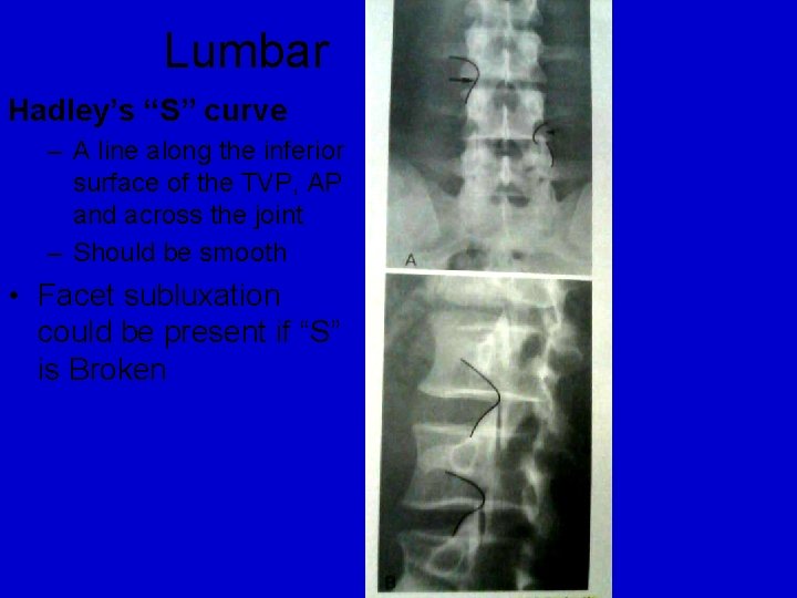 Lumbar Hadley’s “S” curve – A line along the inferior surface of the TVP,