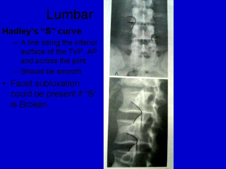 Lumbar Hadley’s “S” curve – A line along the inferior surface of the TVP, Lumbar Hadley’s “S” curve – A line along the inferior surface of the TVP,