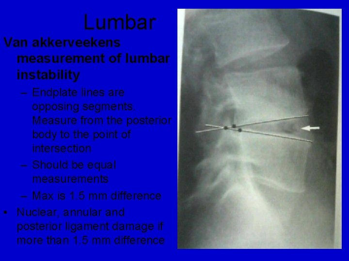 Lumbar Van akkerveekens measurement of lumbar instability – Endplate lines are opposing segments. Measure