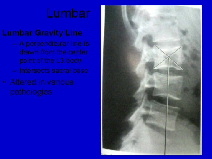 Lumbar Gravity Line – A perpendicular line is drawn from the center point of
