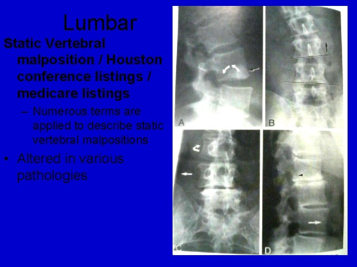 Lumbar Static Vertebral malposition / Houston conference listings / medicare listings – Numerous terms