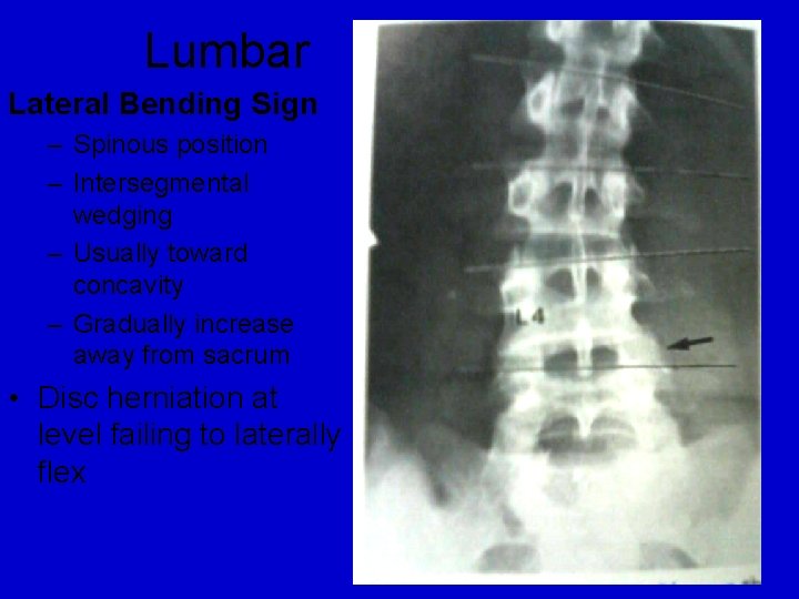 Lumbar Lateral Bending Sign – Spinous position – Intersegmental wedging – Usually toward concavity