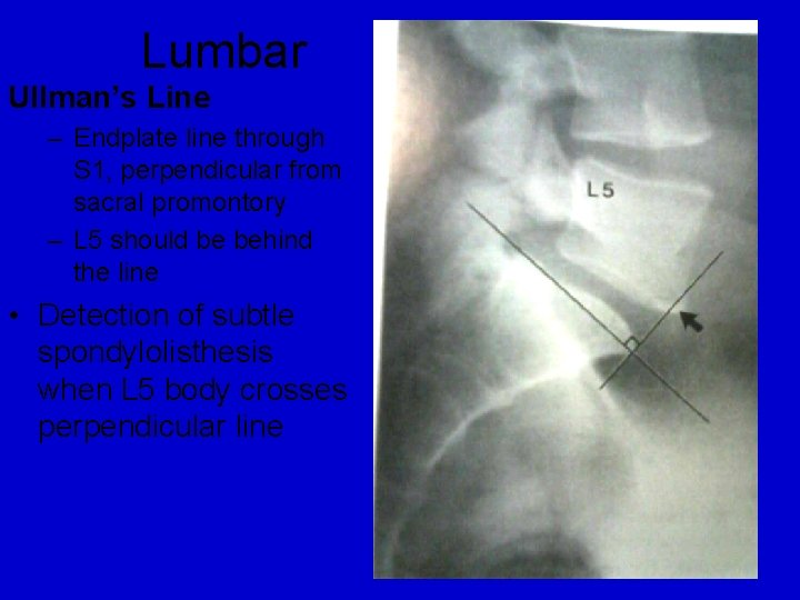 Lumbar Ullman’s Line – Endplate line through S 1, perpendicular from sacral promontory –