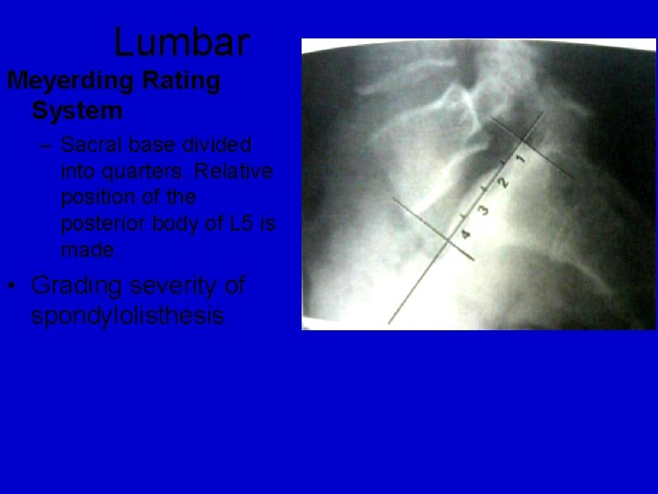 Lumbar Meyerding Rating System – Sacral base divided into quarters. Relative position of the