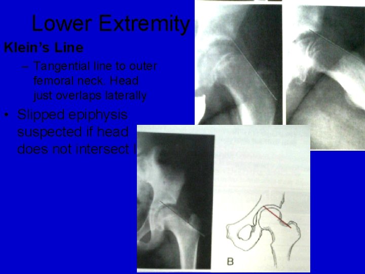 Lower Extremity Klein’s Line – Tangential line to outer femoral neck. Head just overlaps