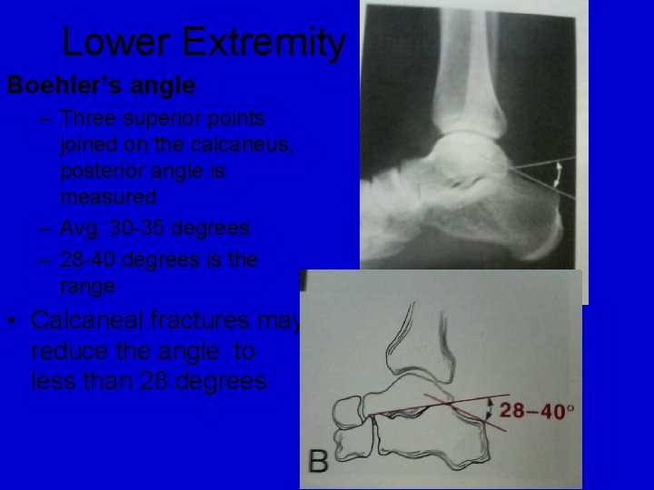 Lower Extremity Boehler’s angle – Three superior points joined on the calcaneus, posterior angle