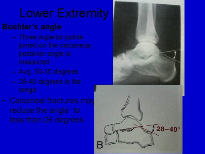 Lower Extremity Boehler’s angle – Three superior points joined on the calcaneus, posterior angle Lower Extremity Boehler’s angle – Three superior points joined on the calcaneus, posterior angle