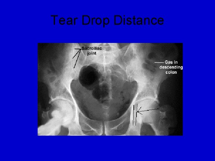 Tear Drop Distance 