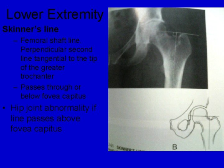 Lower Extremity Skinner’s line – Femoral shaft line. Perpendicular second line tangential to the