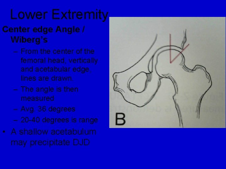 Lower Extremity Center edge Angle / Wiberg’s – From the center of the femoral