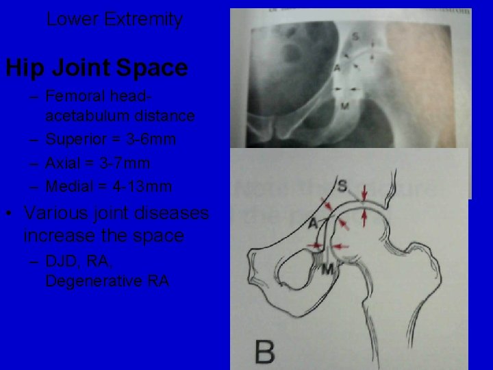 Lower Extremity Hip Joint Space – Femoral headacetabulum distance – Superior = 3 -6