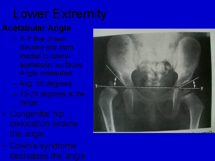 Lower Extremity Acetabular Angle – Y-Y line drawn. Second line from medial to lateral