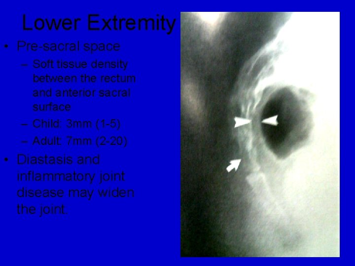 Lower Extremity • Pre-sacral space – Soft tissue density between the rectum and anterior