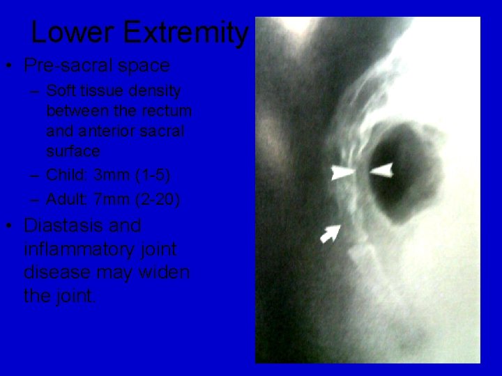 Lower Extremity • Pre-sacral space – Soft tissue density between the rectum and anterior Lower Extremity • Pre-sacral space – Soft tissue density between the rectum and anterior