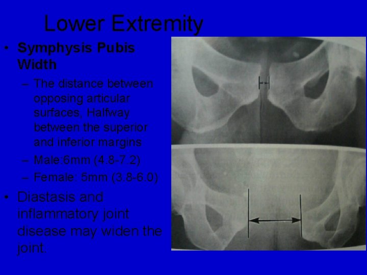 Lower Extremity • Symphysis Pubis Width – The distance between opposing articular surfaces, Halfway