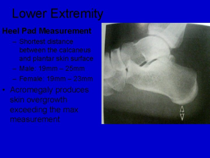 Lower Extremity Heel Pad Measurement – Shortest distance between the calcaneus and plantar skin