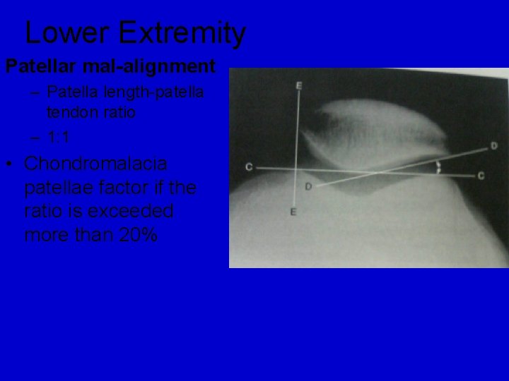 Lower Extremity Patellar mal-alignment – Patella length-patella tendon ratio – 1: 1 • Chondromalacia