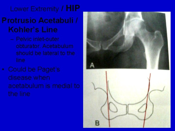 Lower Extremity / HIP Protrusio Acetabuli / Kohler’s Line – Pelvic inlet-outer obturator. Acetabulum