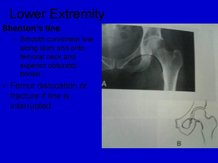 Lower Extremity Shenton’s line – Smooth curvilinear line along ilium and onto femoral neck Lower Extremity Shenton’s line – Smooth curvilinear line along ilium and onto femoral neck