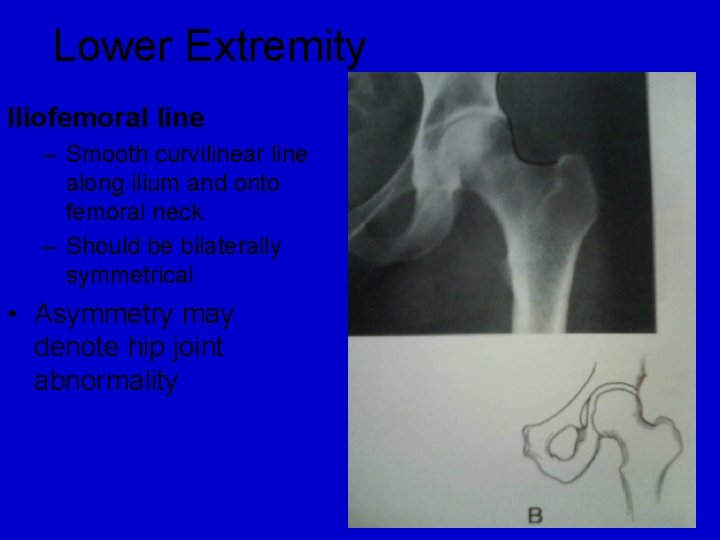 Lower Extremity Iliofemoral line – Smooth curvilinear line along ilium and onto femoral neck