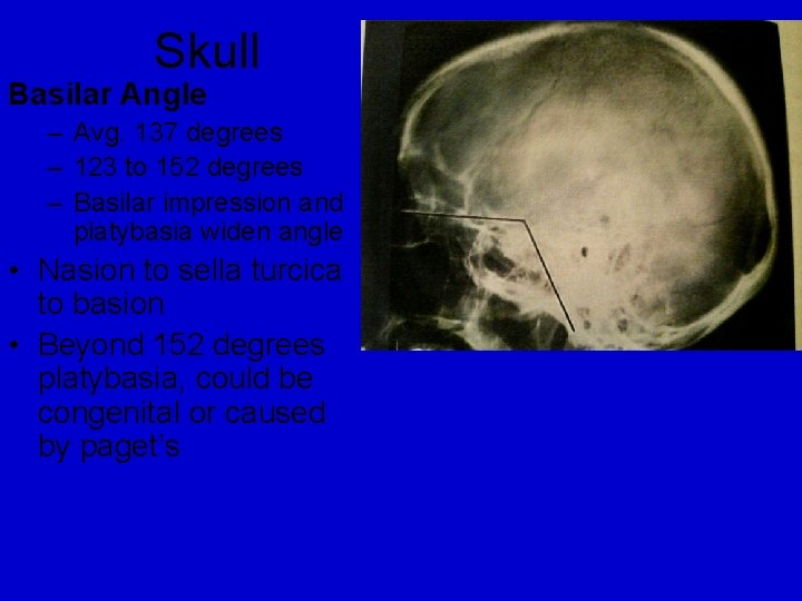 Skull Basilar Angle – Avg. 137 degrees – 123 to 152 degrees – Basilar