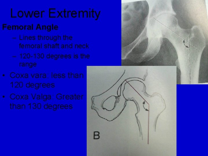 Lower Extremity Femoral Angle – Lines through the femoral shaft and neck – 120